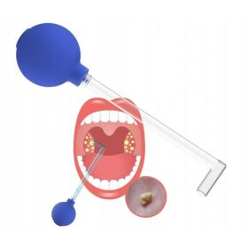    Handgehaltenes Tonsillenreinigungsgerät, Steinentfernungsbirne