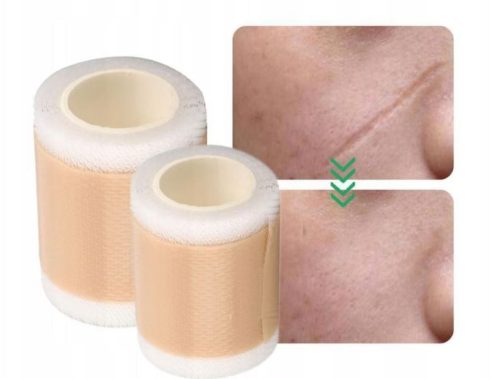 Silikonpflaster zur effektiven Entfernung von postoperativen Narben – 150 cm x 4 cm